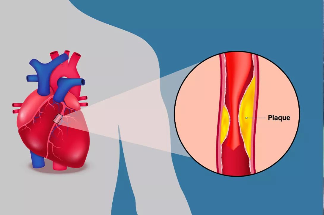 introduction artherosclerose