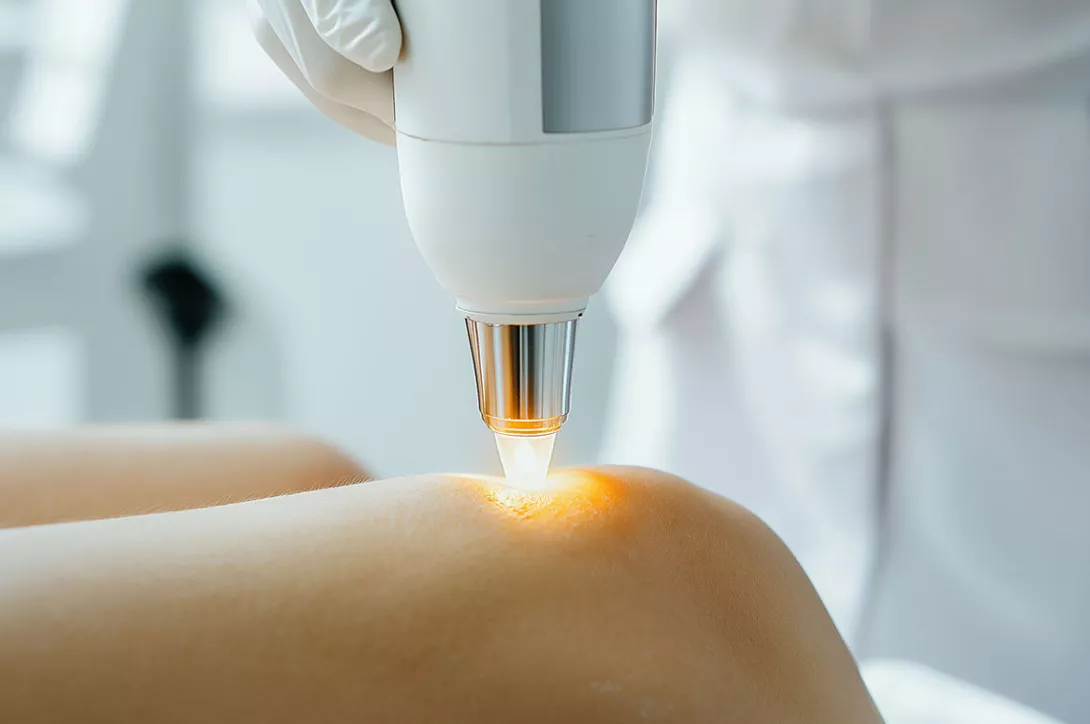 laser vasculaire