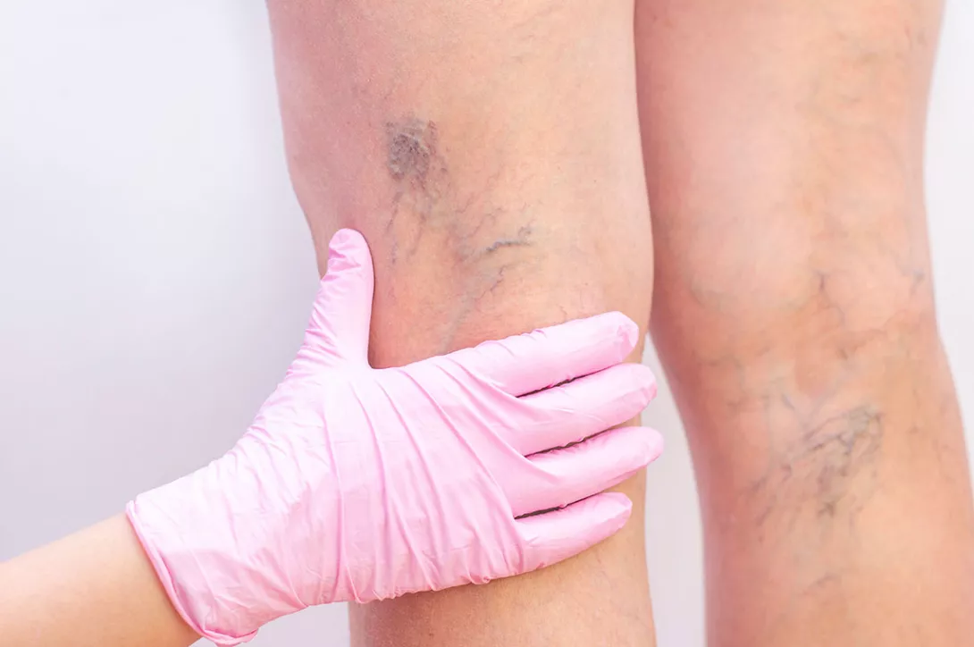 Varicosit&eacute;s jambes, veines apparentes